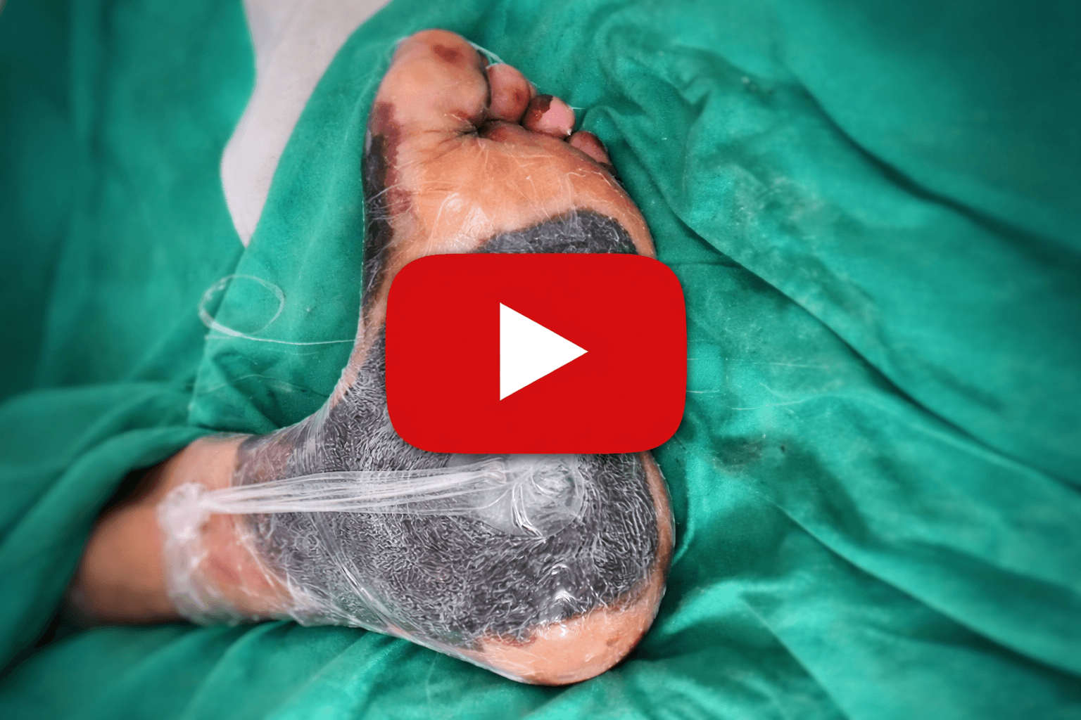 Watch this before trying another neuropathy treatment